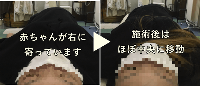 妊婦整体の施術前と施術後の写真